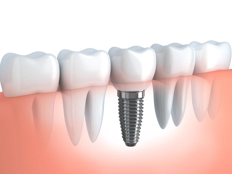 Dental Implants  Picayune, MS 